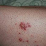 Avoid Bed Bug Bites - Bed Bug Registry