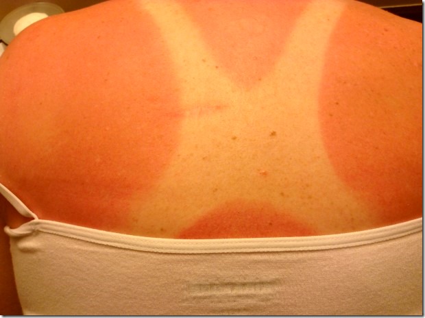 Sunburn from the Equator